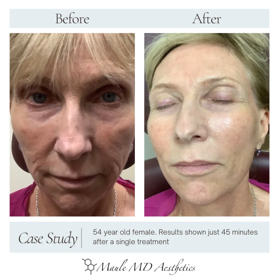 Before and after: 54-year-old female, results shown 45 minutes after a single treatment