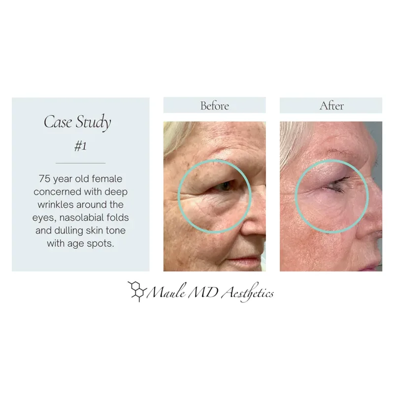 Before and after: 75-year-old female with deep wrinkles around the eyes, nasolabial folds, and age spots
