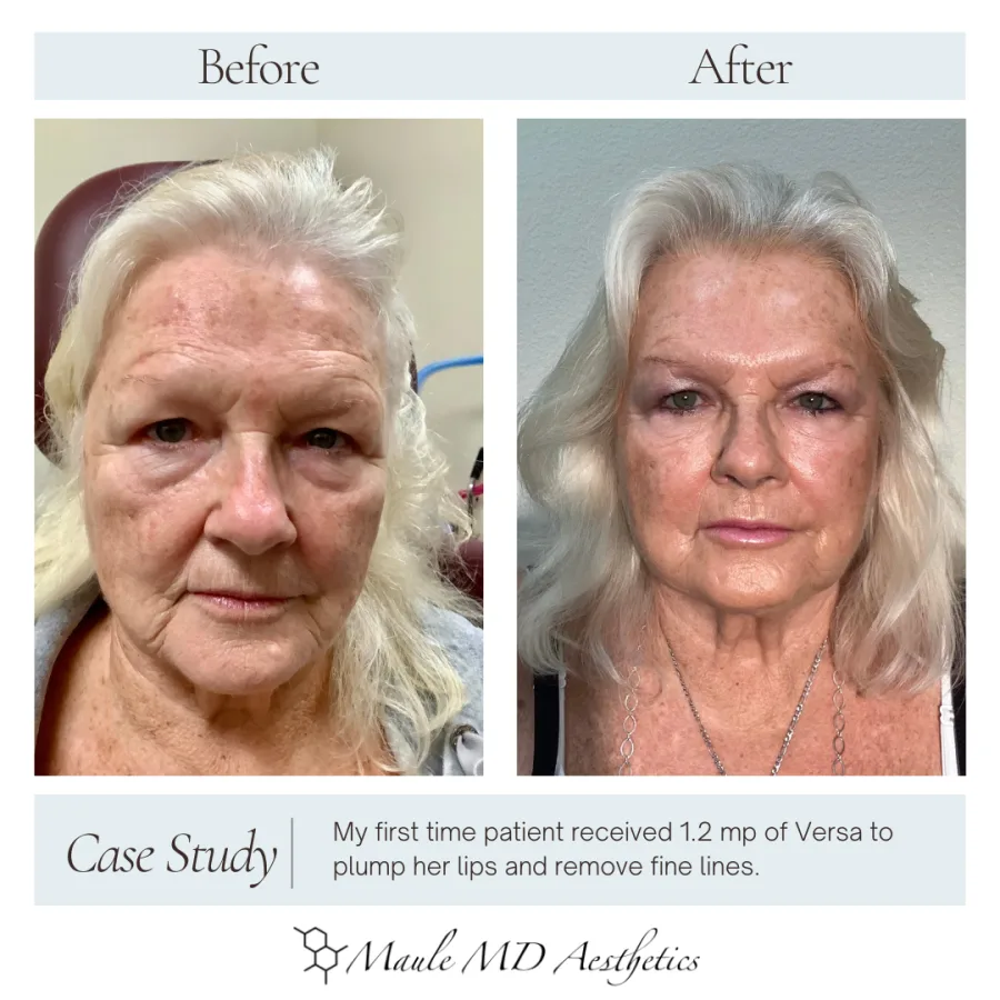 Before and after, front view: first-time patient after 1.2 mL of Versa filler to plump lips and reduce fine lines