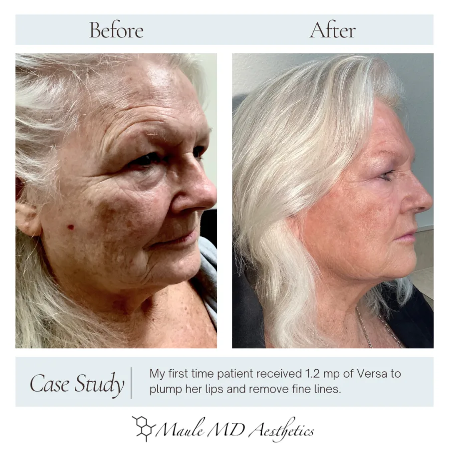 Before and after, right side profile: the same Versa filler patient