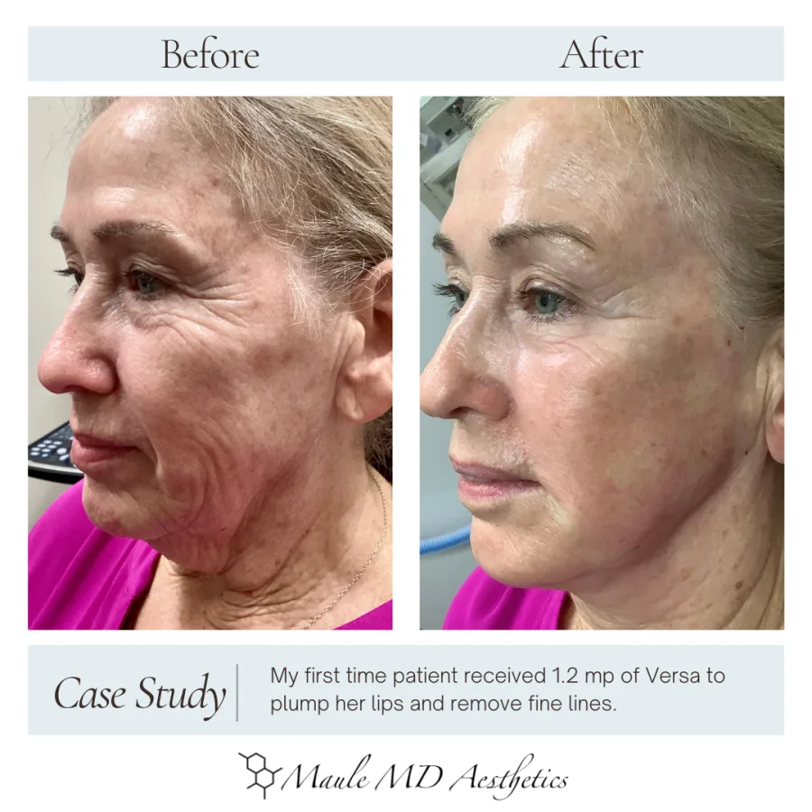 Before and after, left side profile: the same Versa filler patient