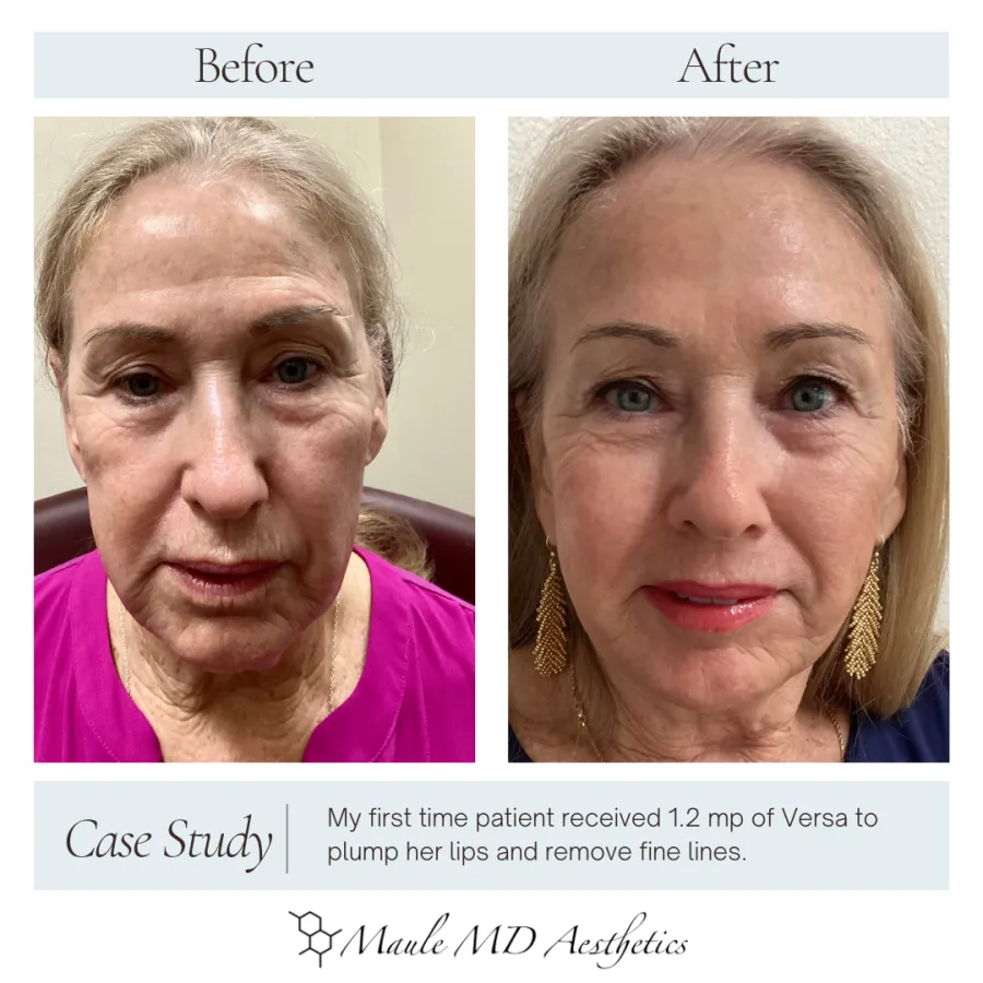 Before and after, front view with makeup: the same Versa filler patient