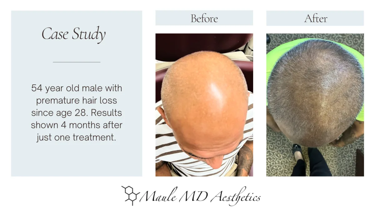 Hair Restoration