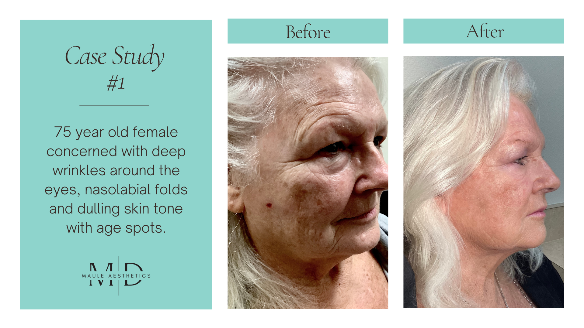 Stem Cell Facelifts