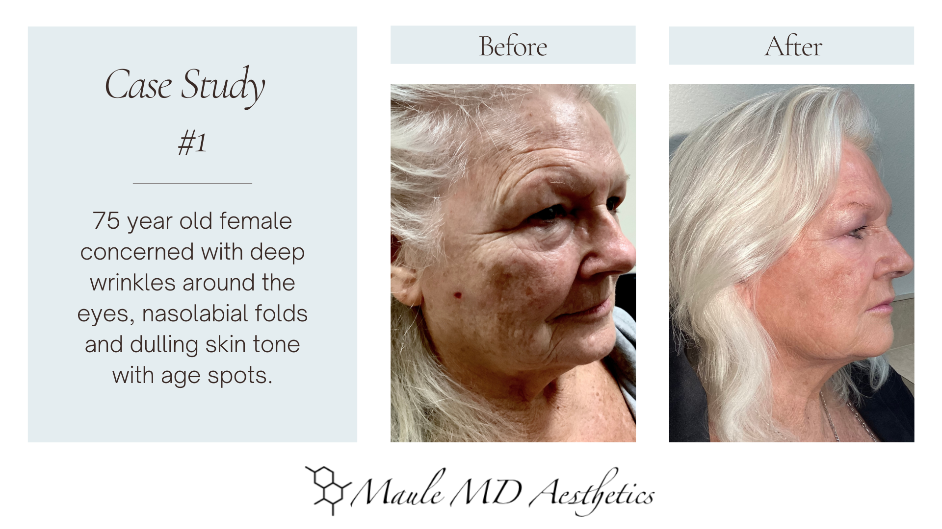 Non-surgical Facelifts
